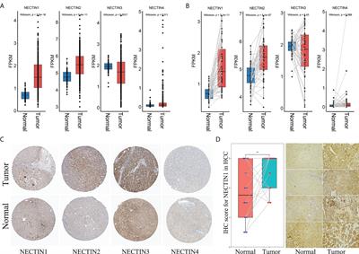 High expression of nectin-1 indicates a poor prognosis and promotes metastasis in hepatocellular carcinoma